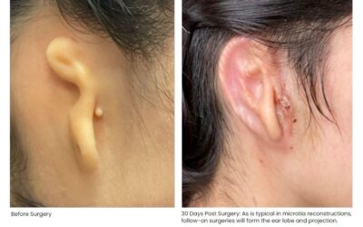 Primeira orelha impressa em 3D é implantada em humano
