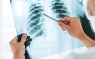 Inteligência artificial consegue prever risco de câncer de pulmão
